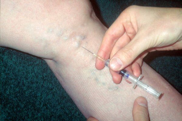 склеротерапија за проширени вени