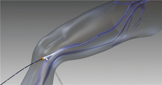 радиофреквентна облитерација за проширени вени