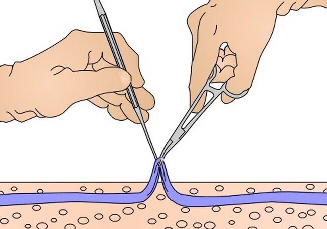 соголување на вените за проширени вени